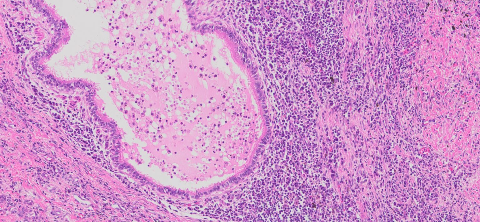 Human Lung Tissue Chronic Inflammation Ffpe Sections