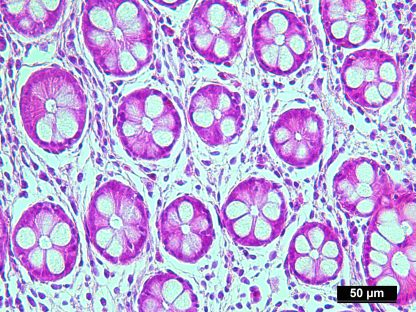 Human Colon Adenocarcinoma Normal Matched Pair Tissue Ffpe Sections