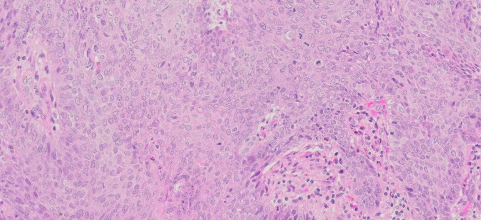 Human Lung Squamous Cell Carcinoma Ffpe Sections