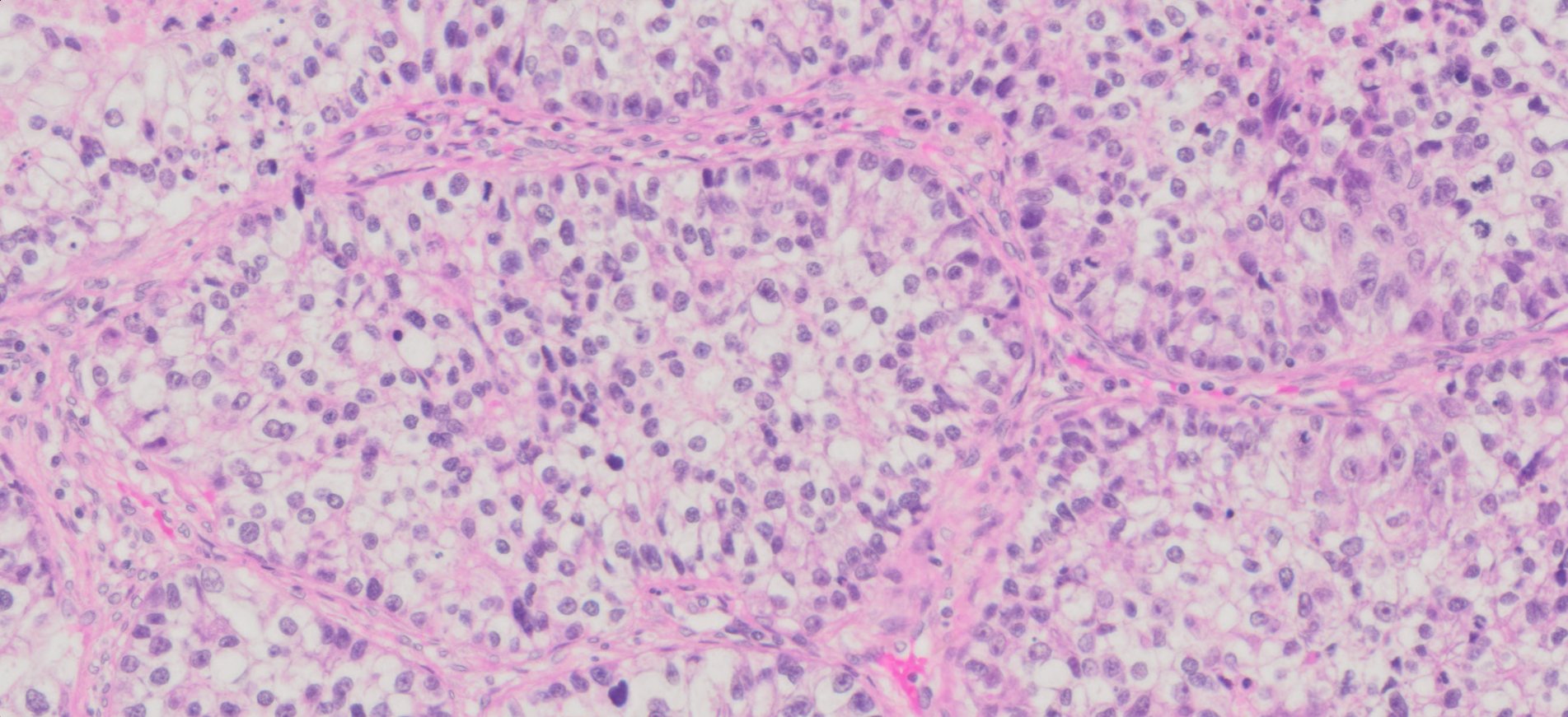 Human Lung Adenocarcinoma FFPE Sections