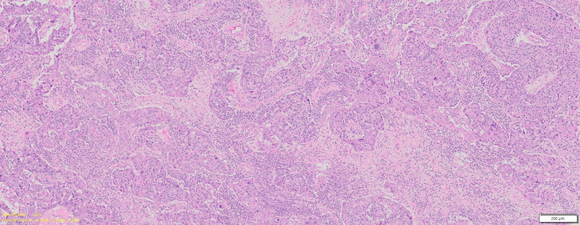 Human Ovary Cancer Serous Cyst Adenocarcinoma FFPE Sections