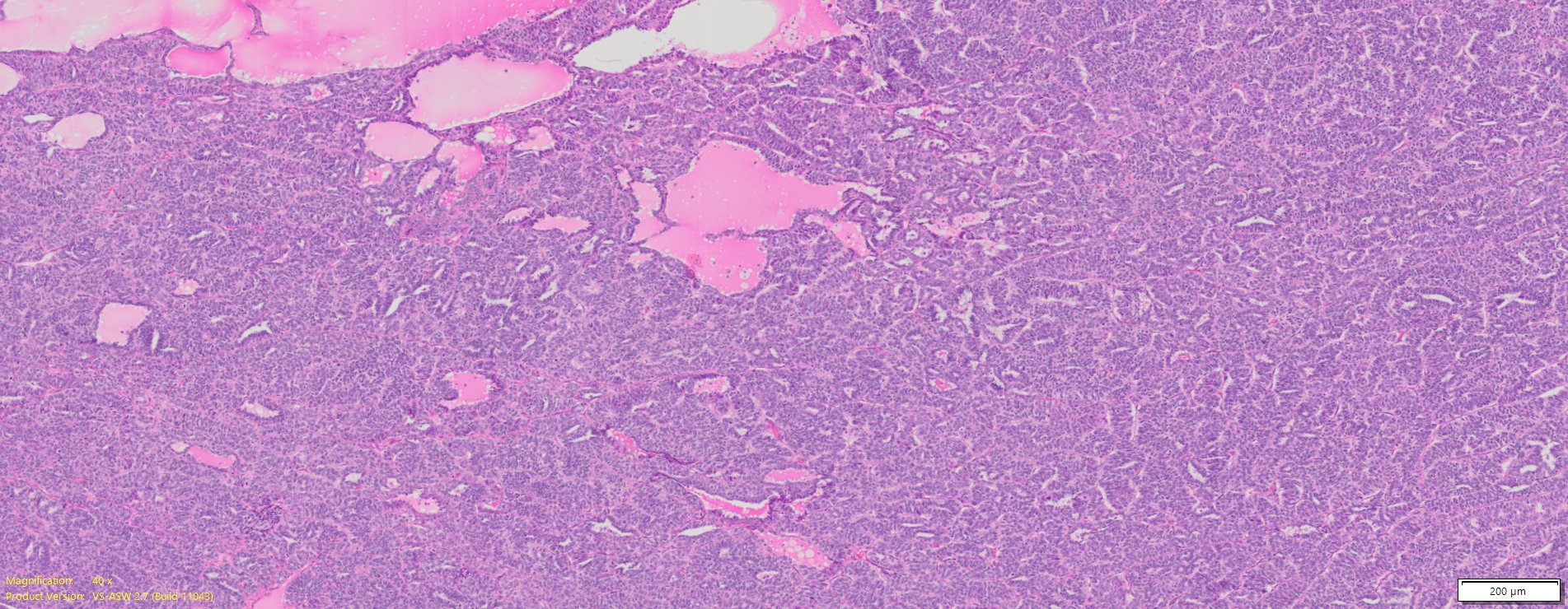 Human Ovary Cancer Serous Cyst Adenocarcinoma FFPE Sections