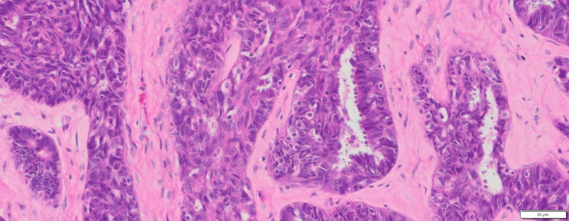 Human Ovary Cancer Serous Cyst Adenocarcinoma Ffpe Sections