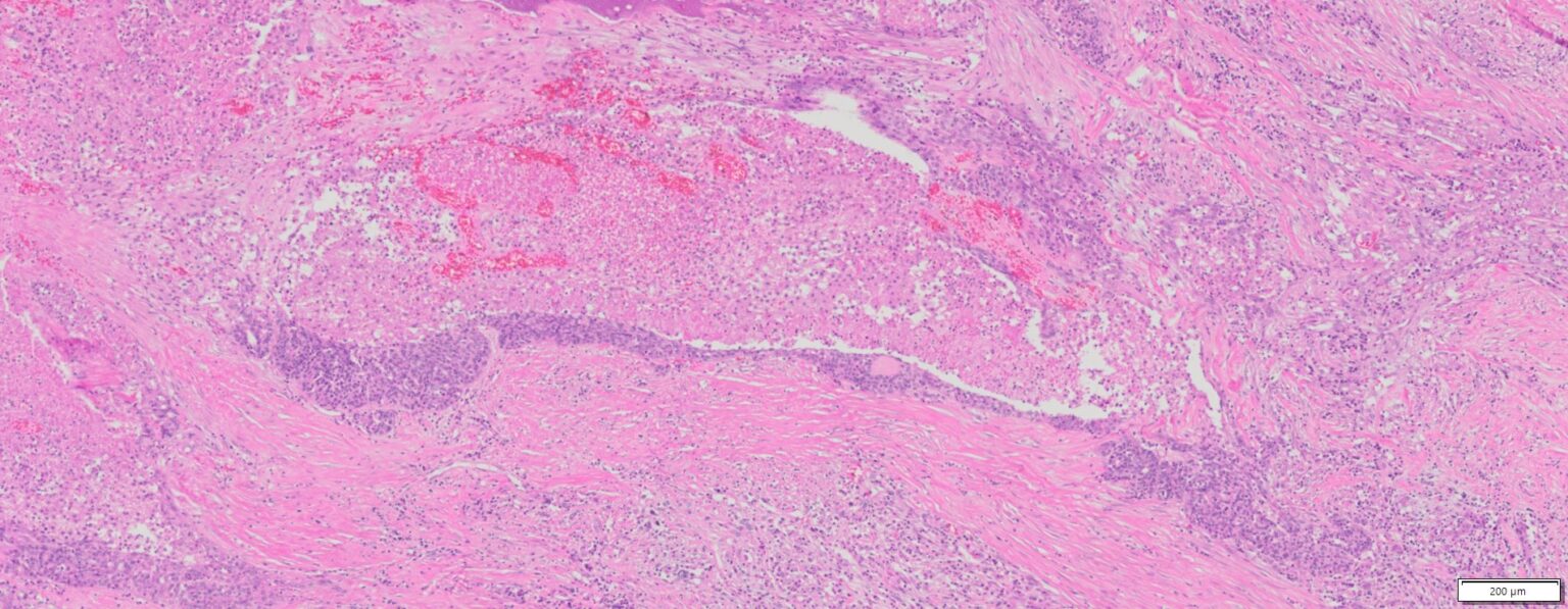 Human Ovary Cancer Serous Cyst Adenocarcinoma Ffpe Sections