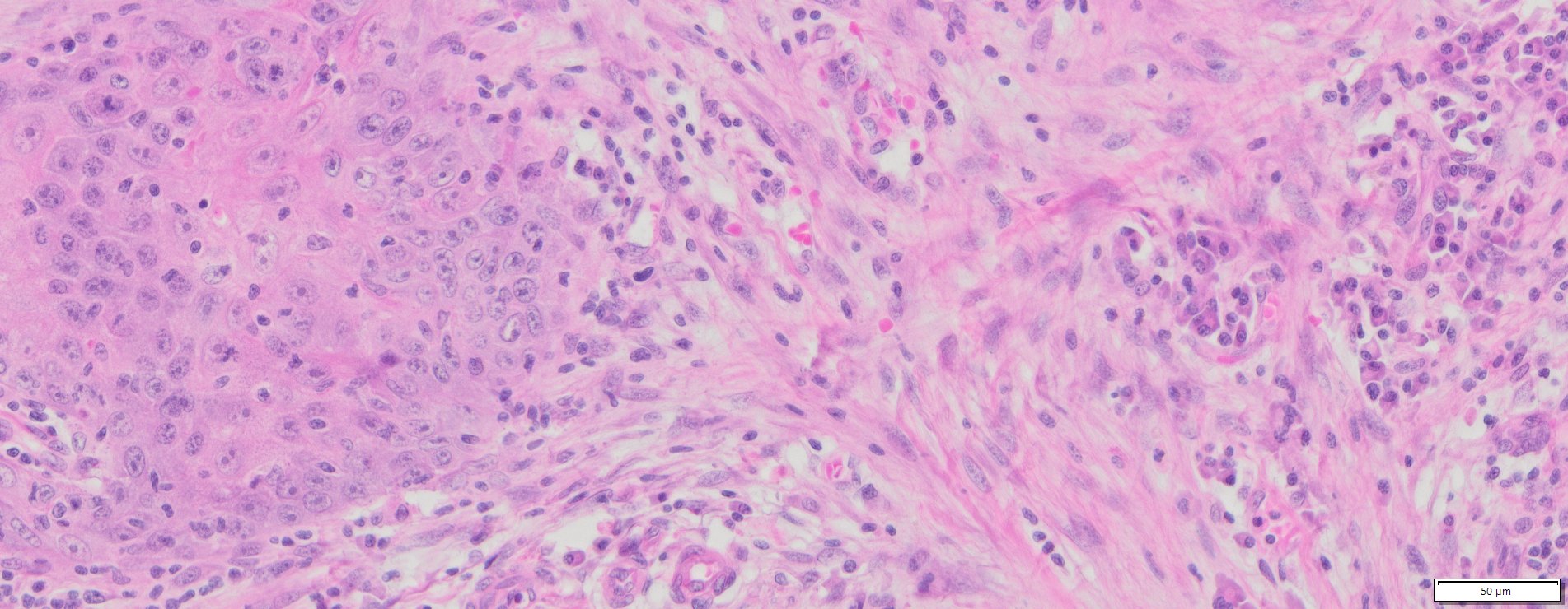 Human Tongue Squamous Cell Carcinoma Ffpe Sections