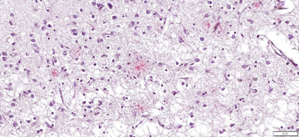 Congo Red amyloid stain human Alzheimer's brain 20x