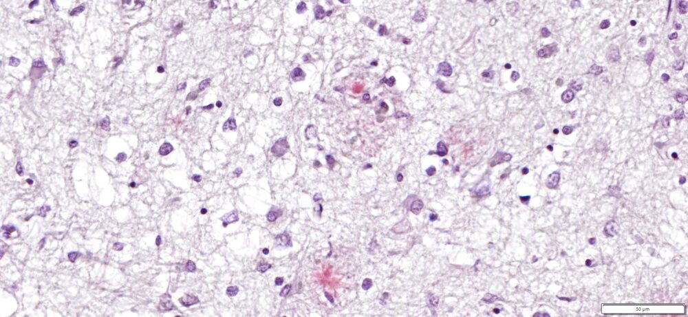 Congo Red amyloid stain human Alzheimer's brain 30x