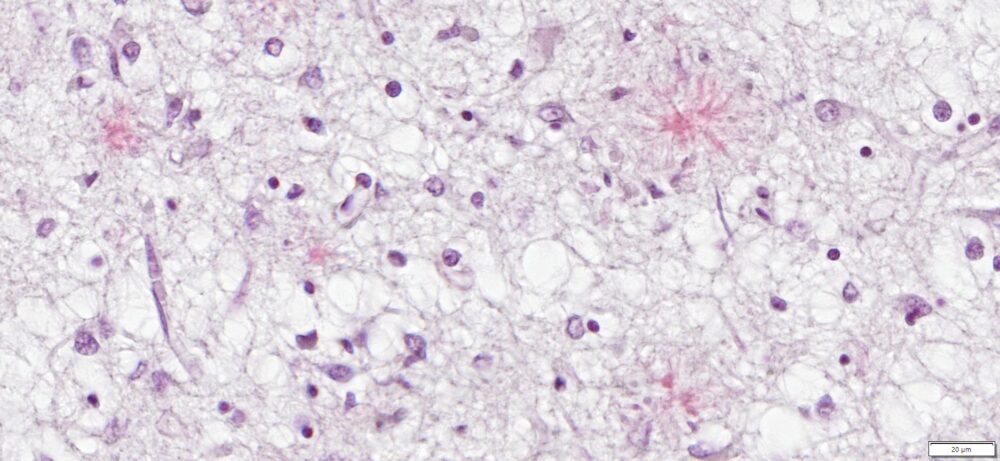 Congo Red amyloid stain human Alzheimer's brain 40x