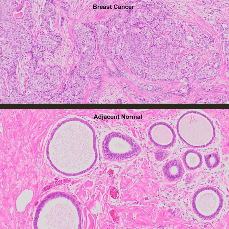 Human Breast Cancer with ER+/PR+/Her2 () & Normal Matched Pair Tissue