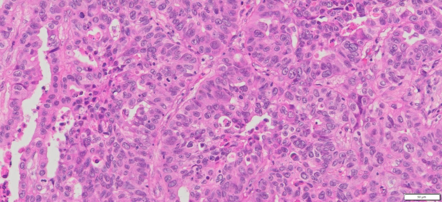 Human Lung Adenocarcinoma Ffpe Sections