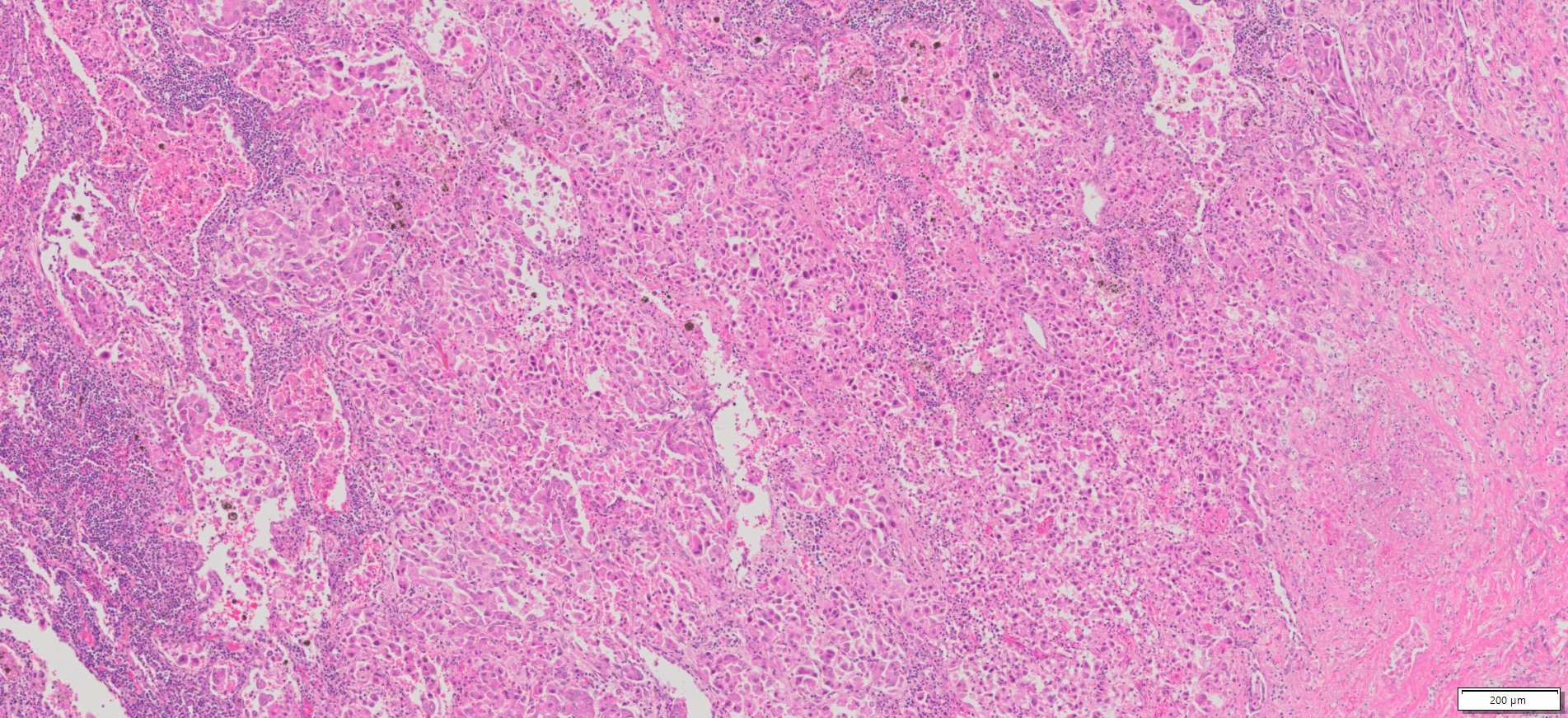 Human Lung Adenocarcinoma FFPE Sections
