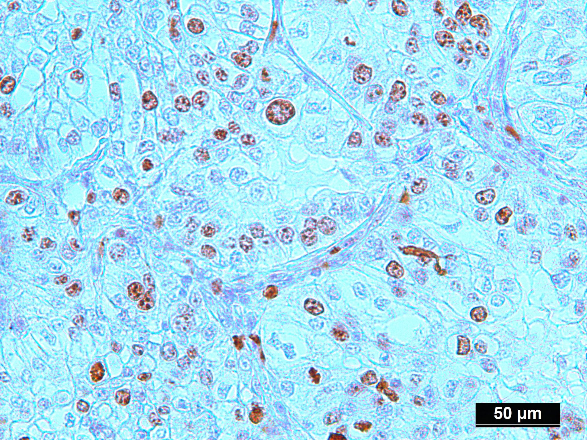 Human Lung Adenocarcinoma FFPE Sections