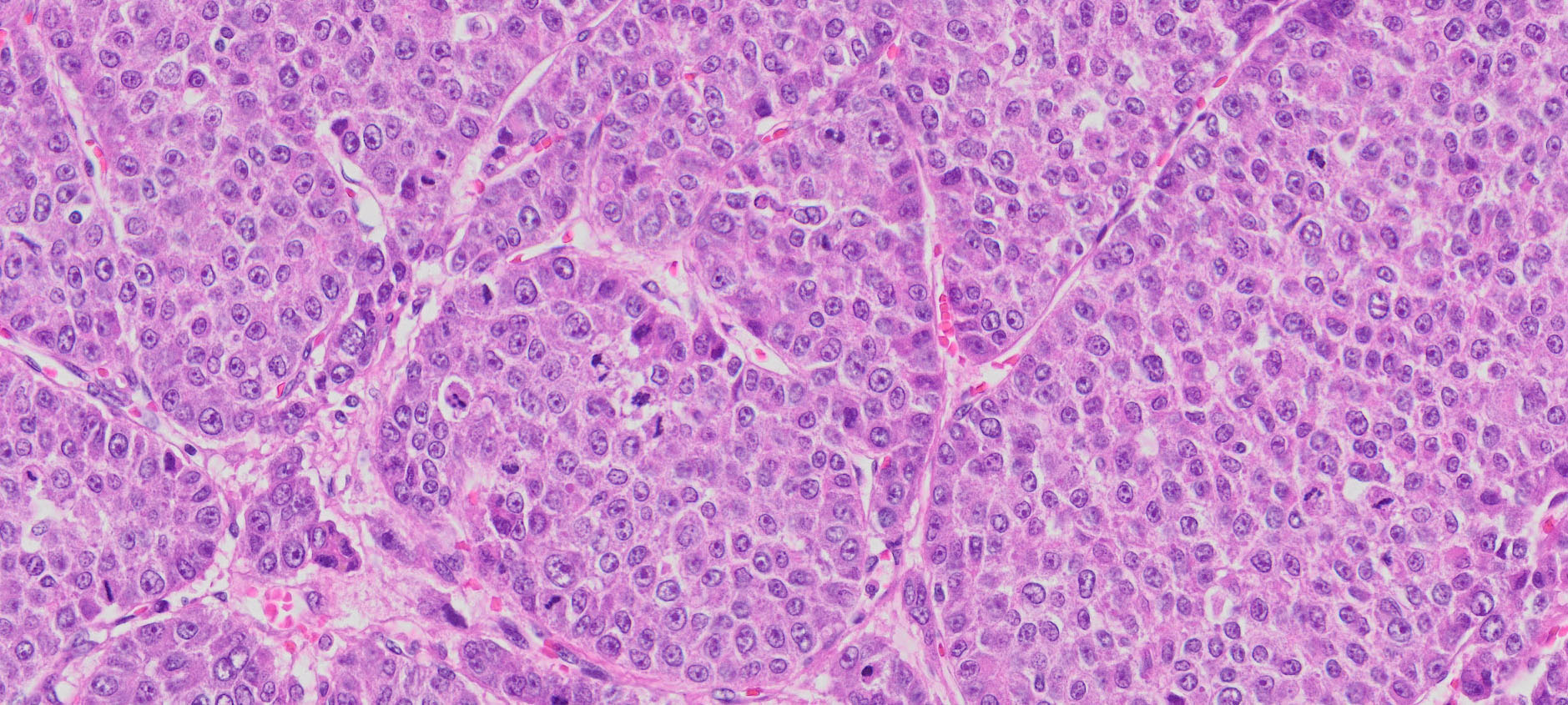 Human Liver Cancer (Hepatocellular carcinoma) FFPE Sections