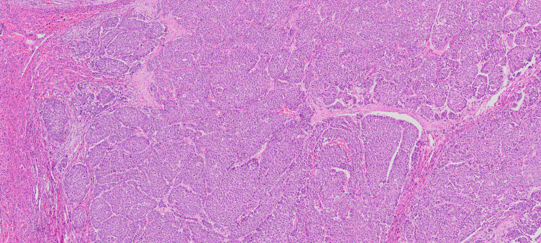 Human Liver Cancer (Hepatocellular carcinoma) FFPE Sections