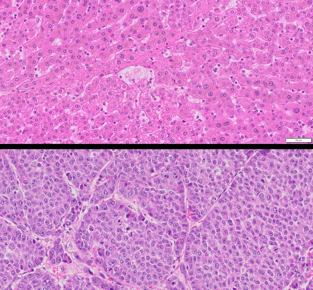HuPS-08002TA Human Liver Cancer and Adjacent Normal Tissue. H&E,20x