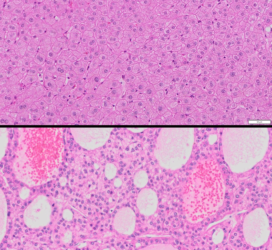 HuPS-08003TA Human Liver Cancer and Adjacent Normal Tissue. H&E,20x