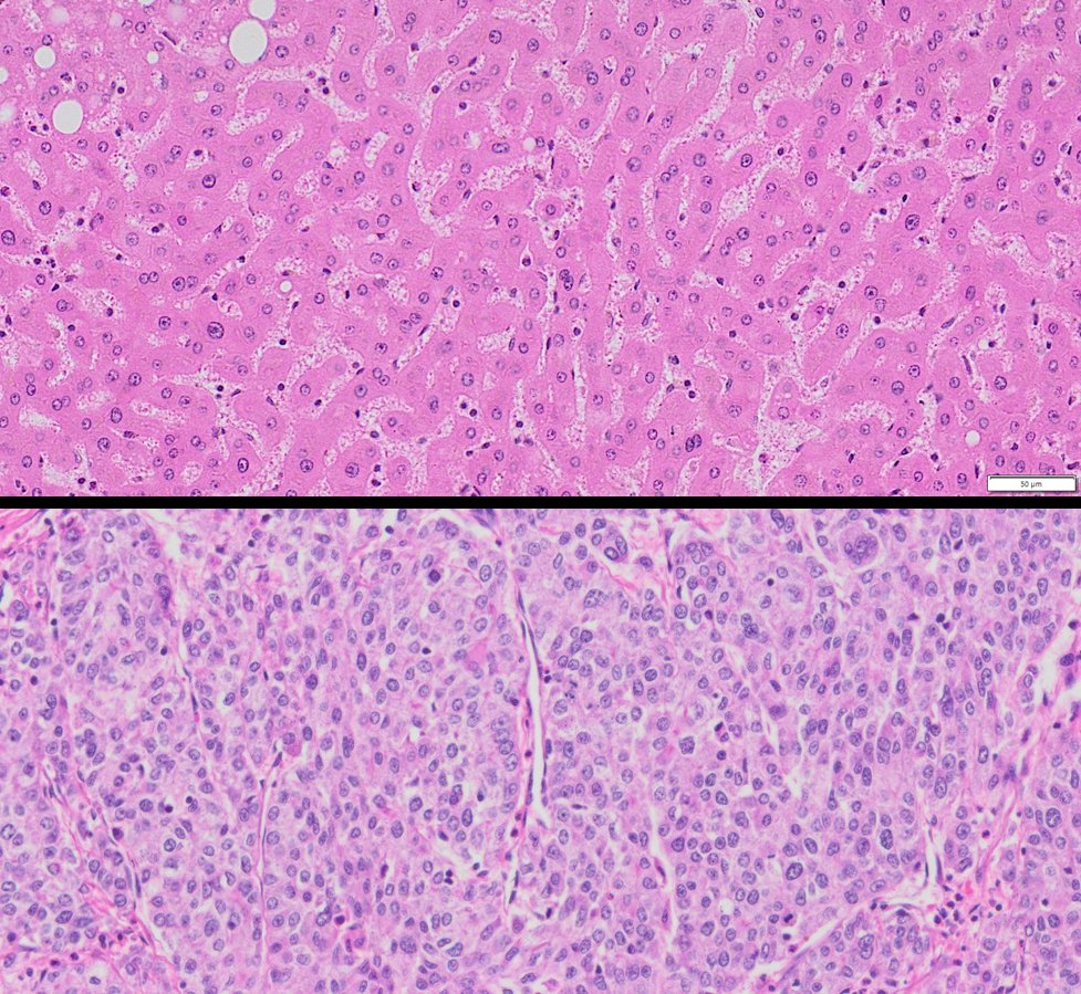 HuPS-08005TA Human Liver Cancer and Adjacent Normal Tissue. H&E,20x