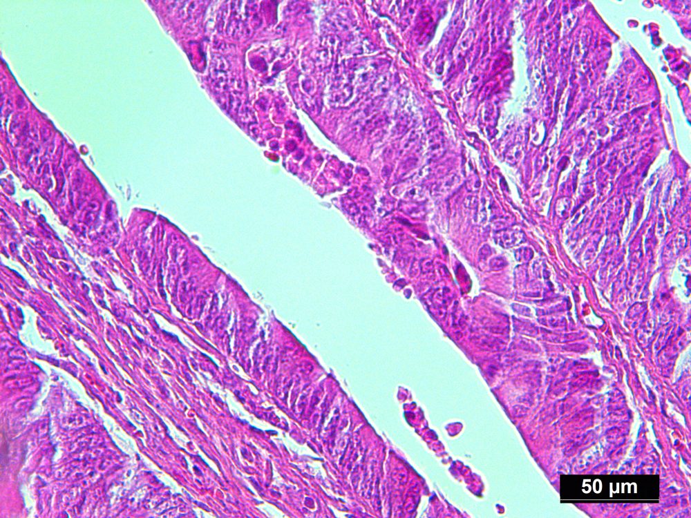 Protein Lysate of Pure Human Colon Adenocarcinoma Cells Isolated by LCM ...