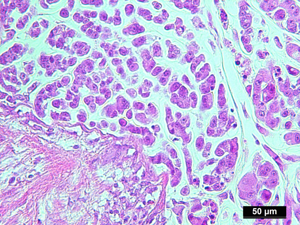 Pure Human Colon Adenocarcinoma Cells Isolated by LCM from FFPE Sample