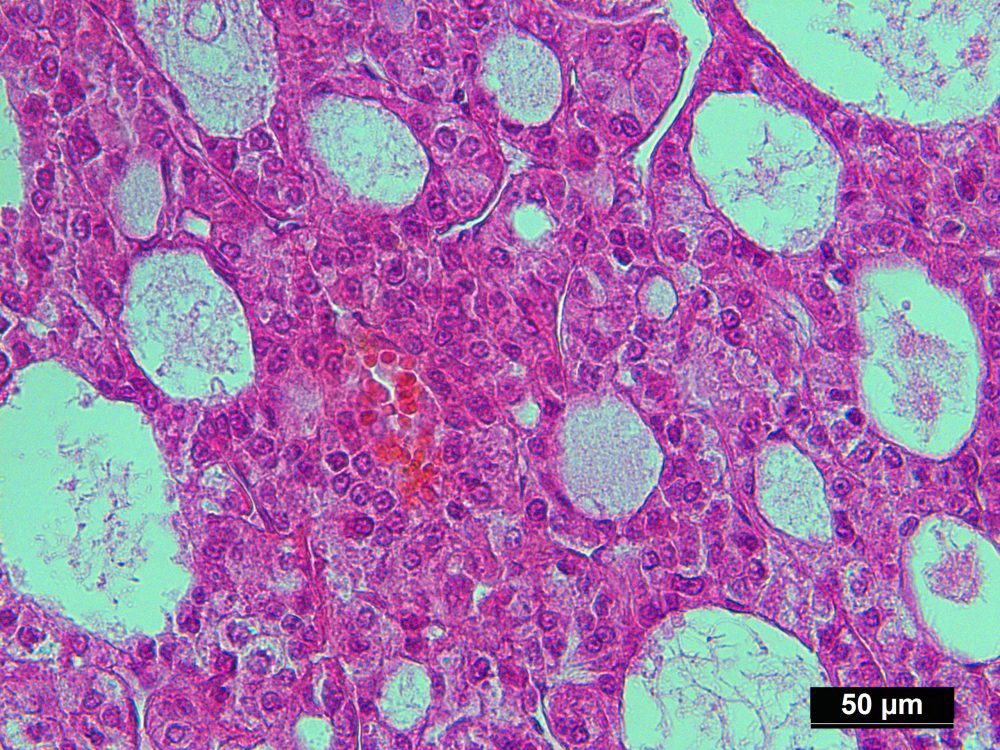 Pure Human Liver Cancer Isolated by LCM from FFPE Sample