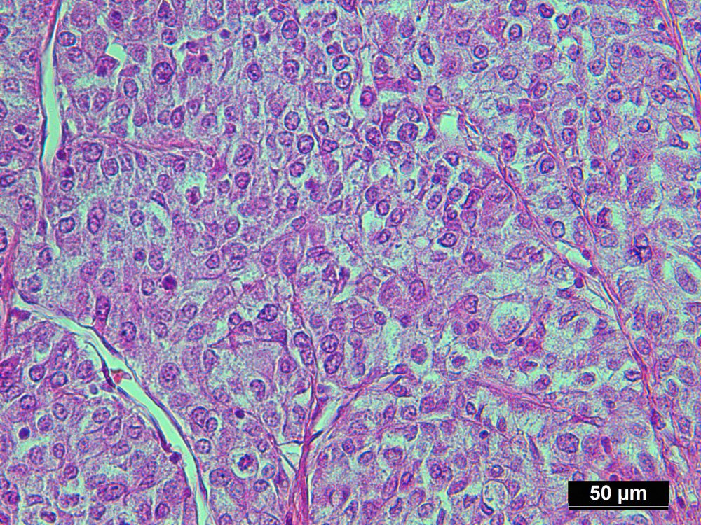 Human Liver Cancer Ffpe Sections