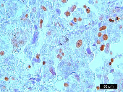Genomic DNA Extracted from Pure Human Lung Adenocarcinoma Cells ...