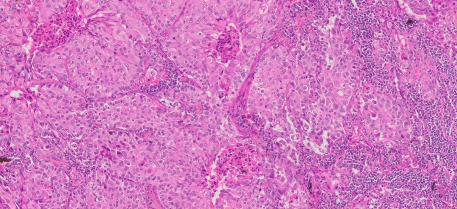 Human Lung Adenocarcinoma FFPE Sections