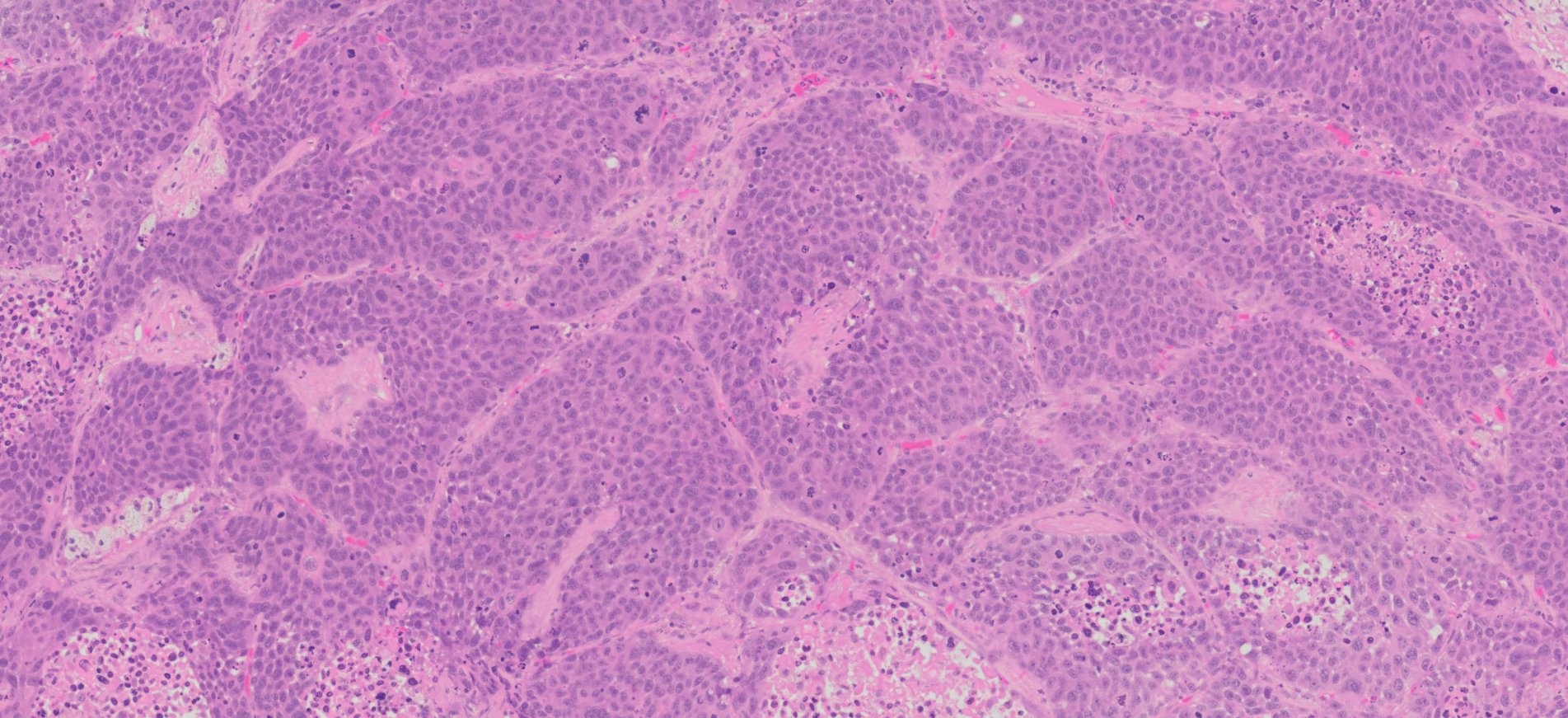 Human Lung Squamous Cell Carcinoma FFPE Sections