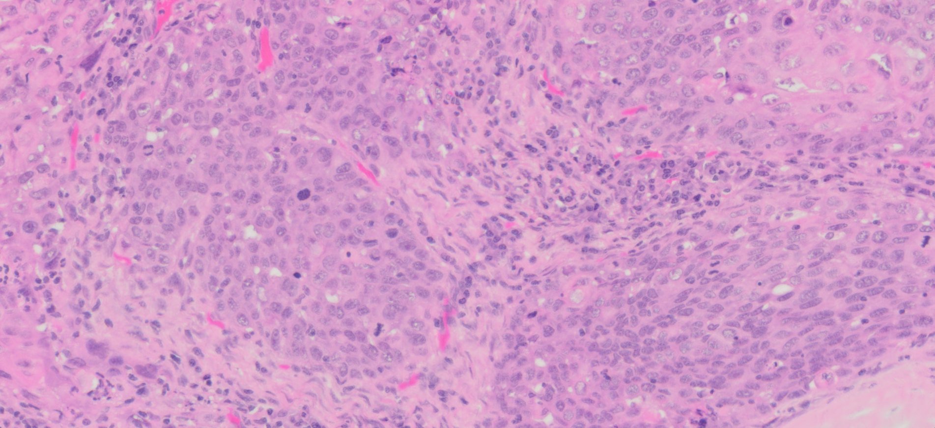 Human Lung Squamous Cell Carcinoma FFPE Sections