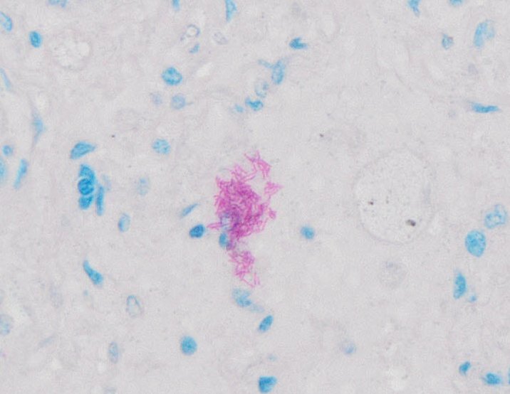 Human Lung FFPE Section, ACID-FAST BACTERIA (AFB) STAIN, 40x