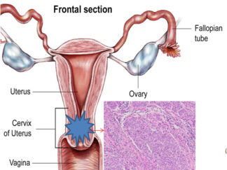 Human Cervical Cancer FFPE Sections
