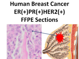 Human Breast Cancer, Triple Positive (ER+/PR+/Her2+), FFPE Sections