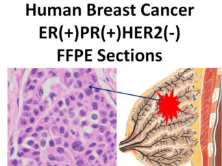 Human Breast Cancer (ER+/PR+/Her2-), FFPE Sections