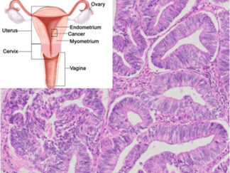 Human Endometrial Cancer FFPE Sections