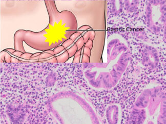Human Gastric Cancer Sections