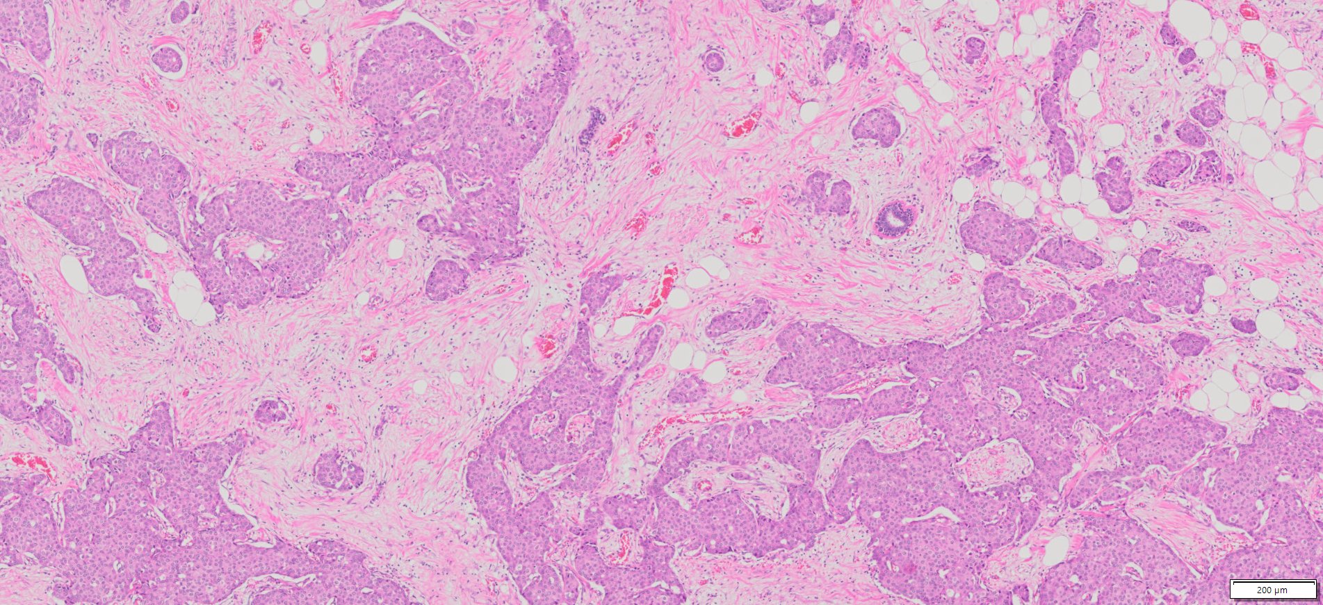 Human Breast Cancer (ER+/PR+/Her2-), (Infiltrating duct carcinoma) FFPE ...