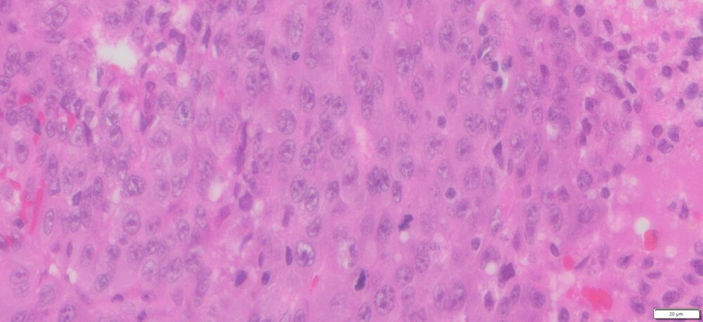 human-liver-cancer-hepatocellular-carcinoma-ffpe-sections