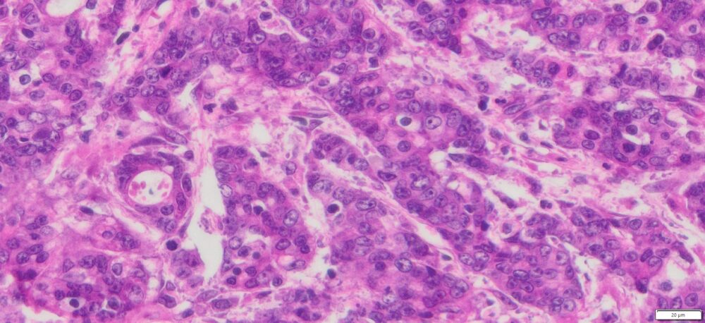 Human Gastric (Stomach adenocarcinoma) FFPE Sections