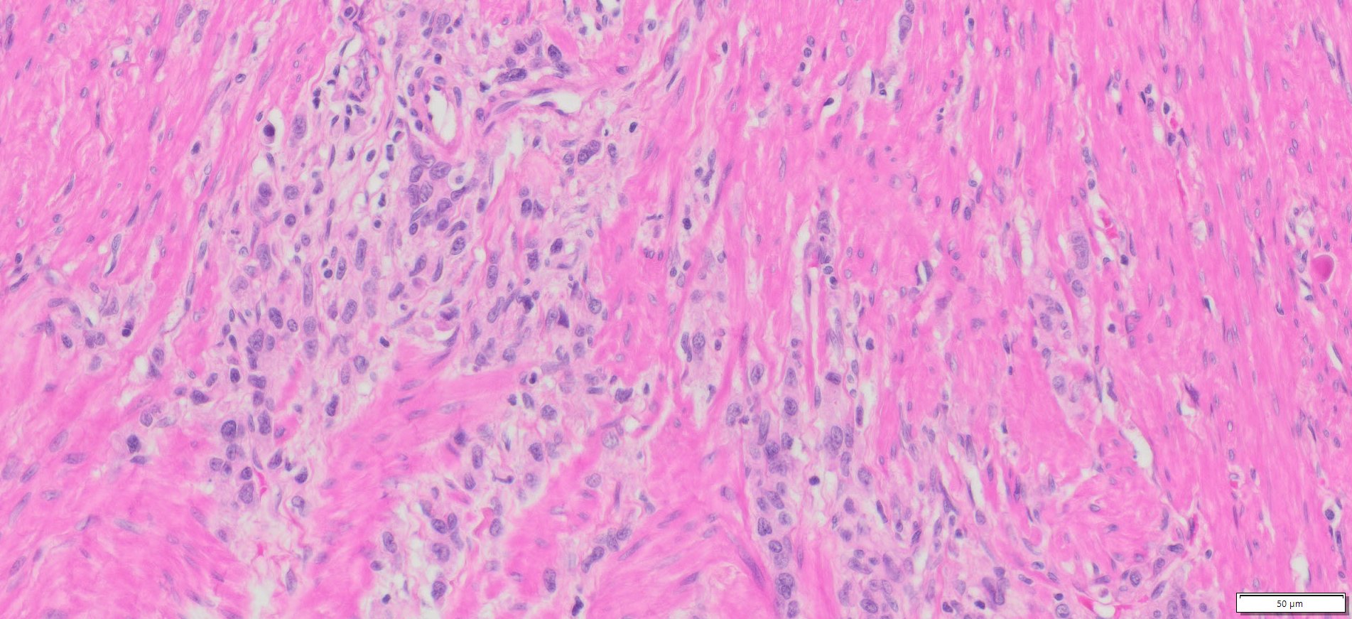 Human Gastric (Stomach adenocarcinoma) FFPE Sections