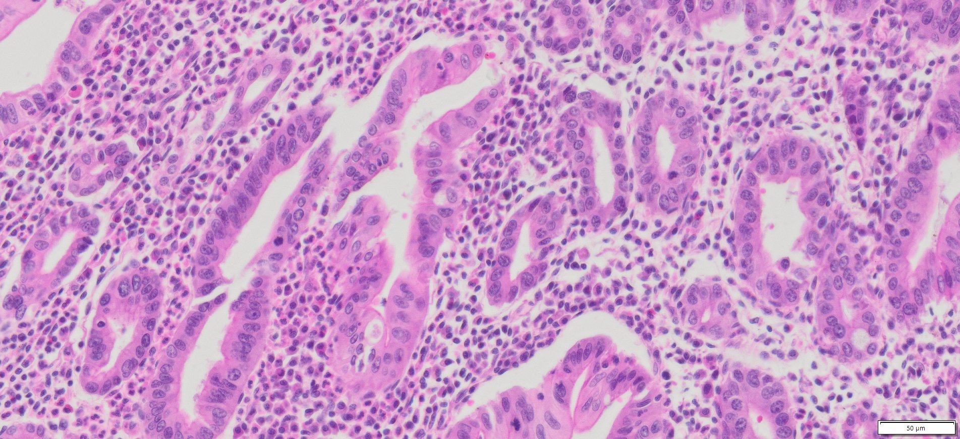 Human Gastric (Stomach adenocarcinoma) FFPE Sections