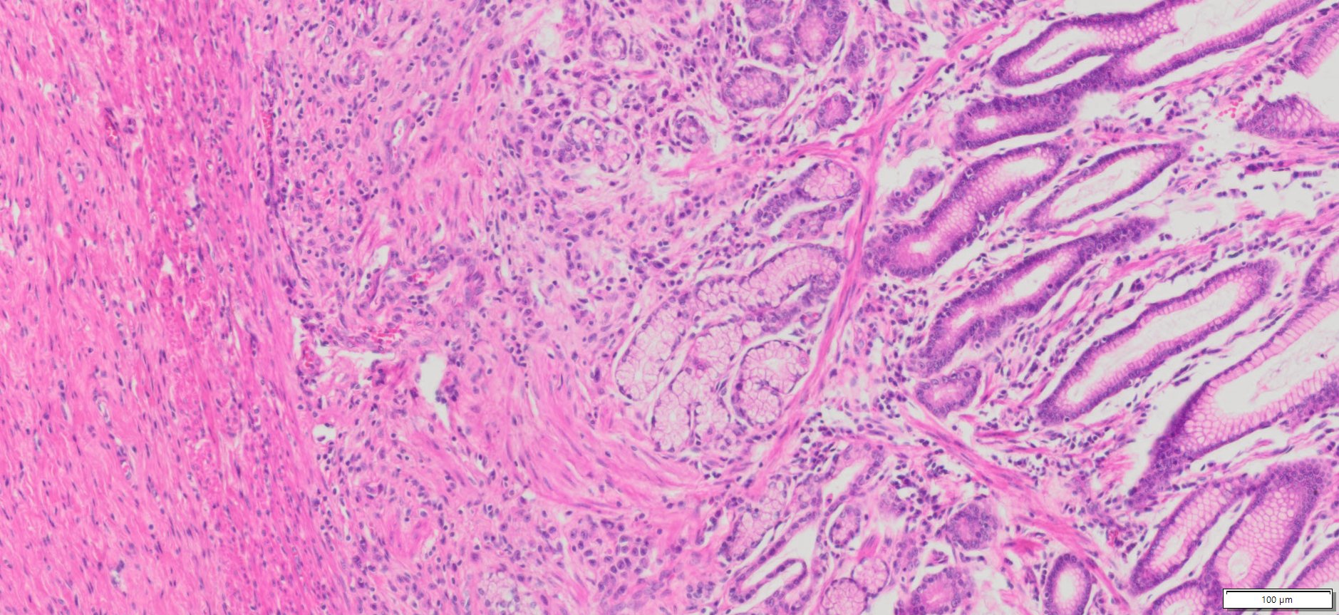 Human Gastric (Diffuse Type Stomach Adenocarcinoma) FFPE Sections
