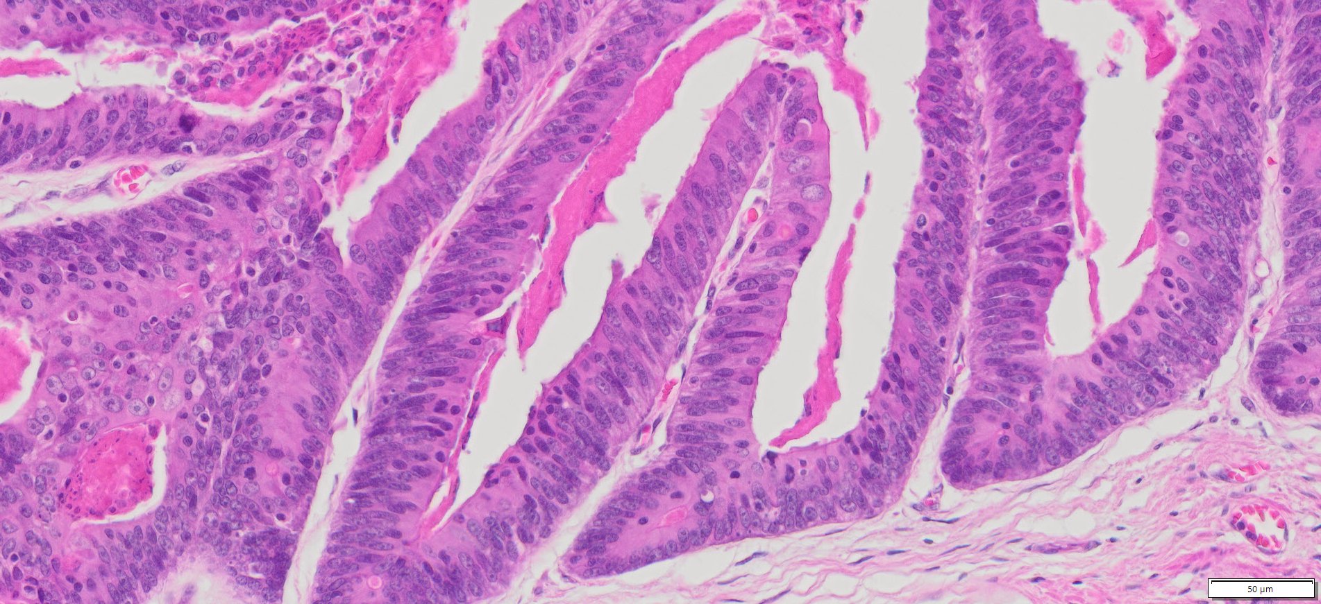 Human Gastric (Stomach adenocarcinoma) FFPE Sections