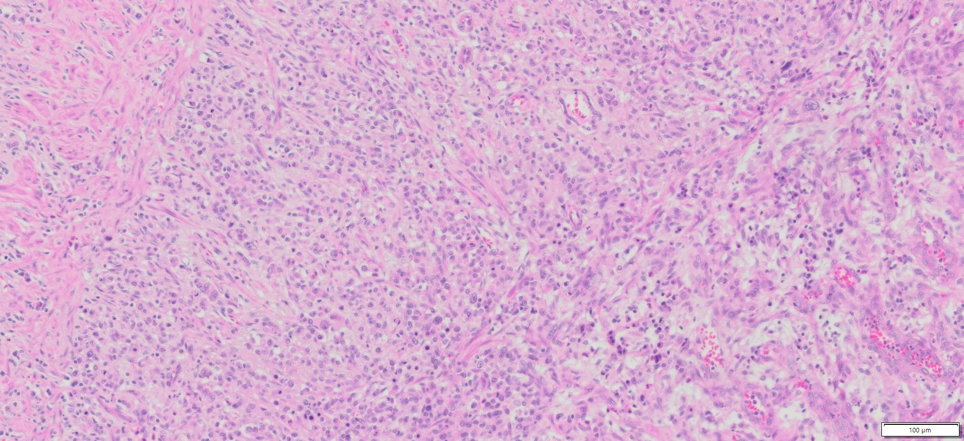Human Gastric (Diffuse type stomach adenocarcinoma) FFPE Sections