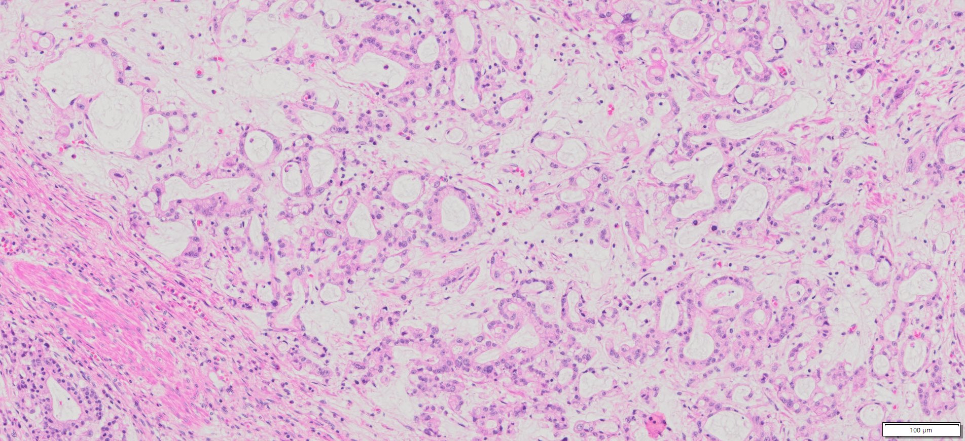 Human Gastric Adenocarcinoma Of Intestinal Type FFPE Sections