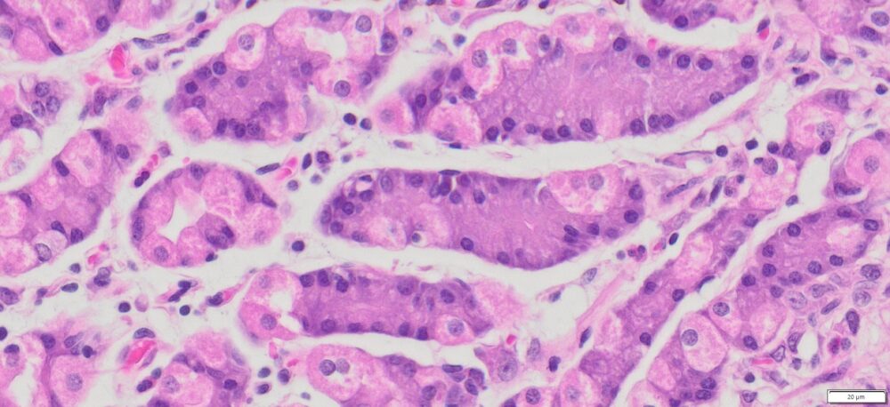 Human Gastric (Stomach adenocarcinoma of non-signet ring cell) FFPE ...