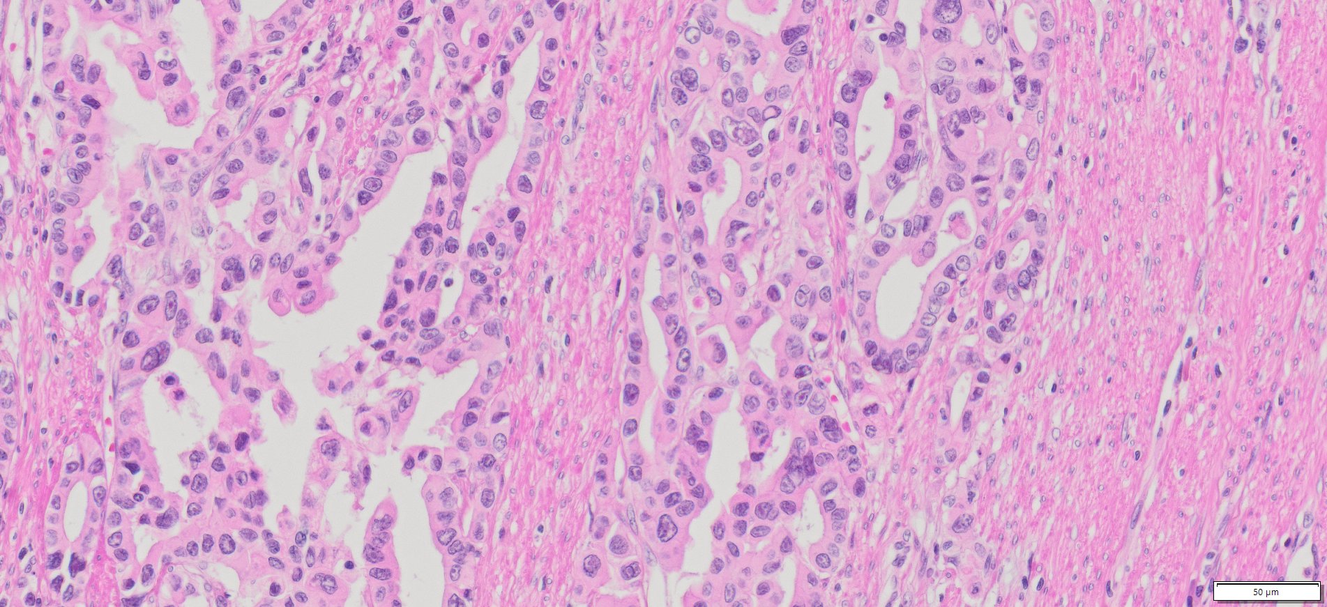 Human Gastric (Stomach adenocarcinoma) FFPE Sections