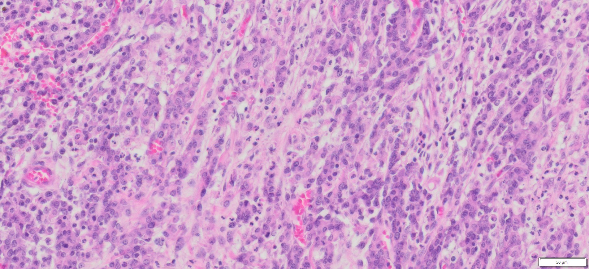 Human Gastric (Stomach adenocarcinoma) FFPE Sections