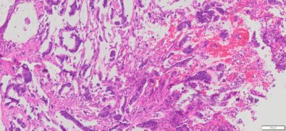 Human Gastric (Mucinous stomach adenocarcinoma) FFPE Sections