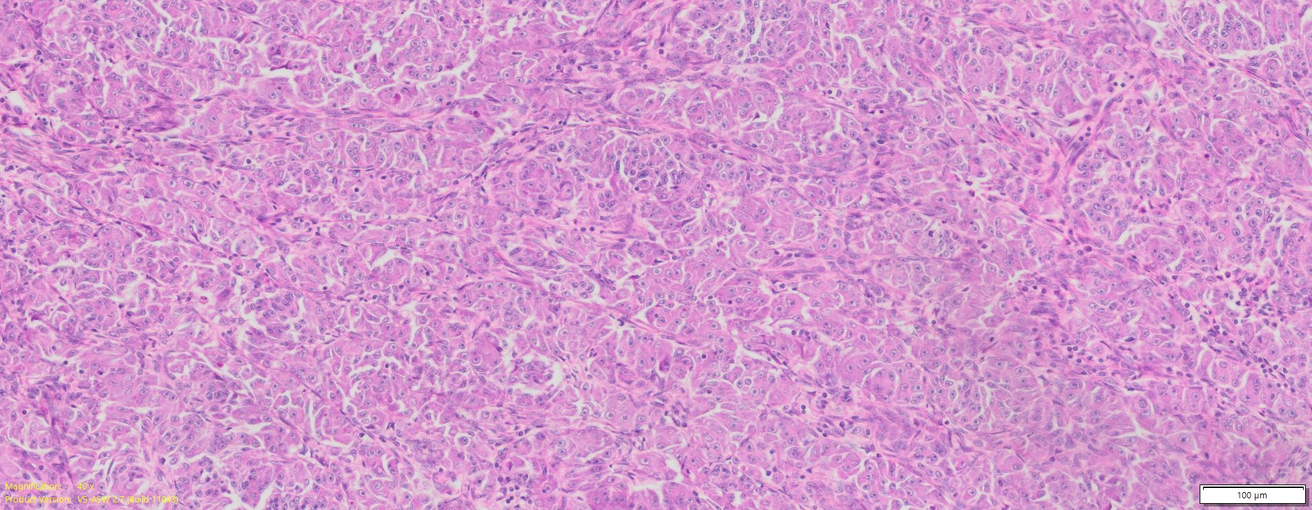 Human Ovary Cancer (Serous cyst adenocarcinoma) FFPE Sections