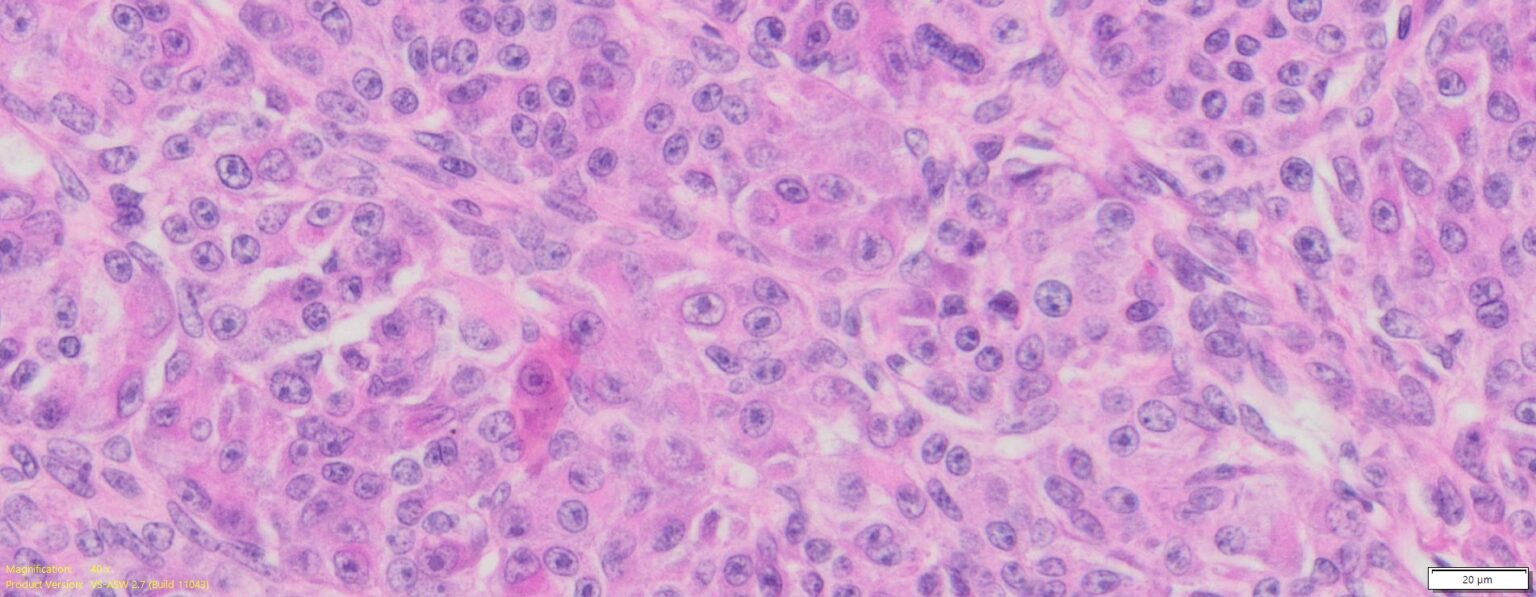 Human Ovary Cancer (Serous cyst adenocarcinoma) FFPE Sections